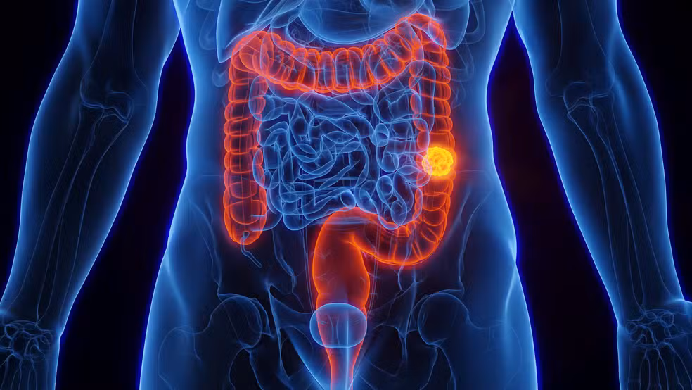 Câncer de intestino: SUS adota novo exame para 40 milhões de brasileiros