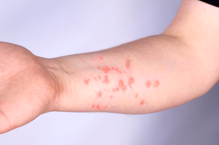 Cuiabá alerta para Mpox mesmo sem casos registrados